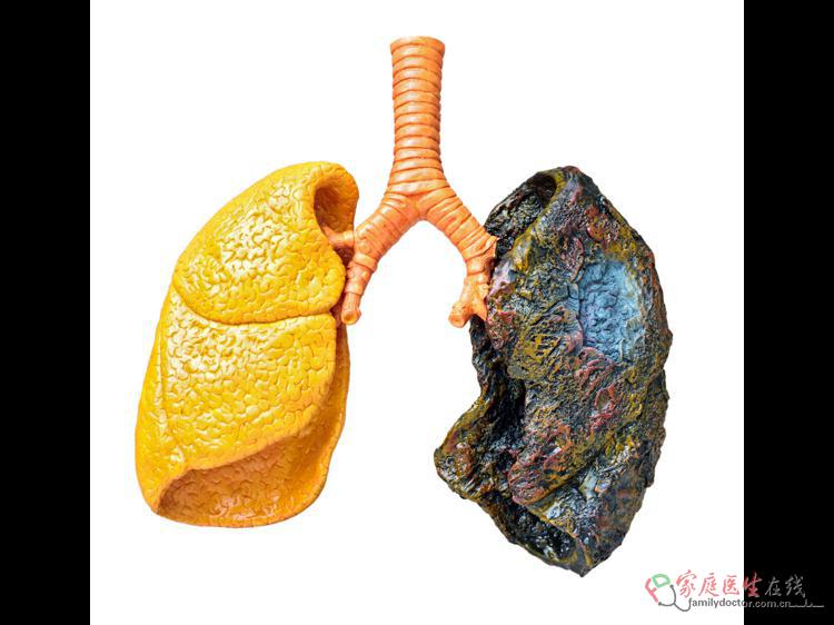 别混淆!痰湿和咳嗽咳痰不是一回事(图1) 别混淆!痰湿和咳嗽咳痰不是一回事