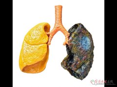 别混淆！痰湿和咳嗽咳痰不是一回事