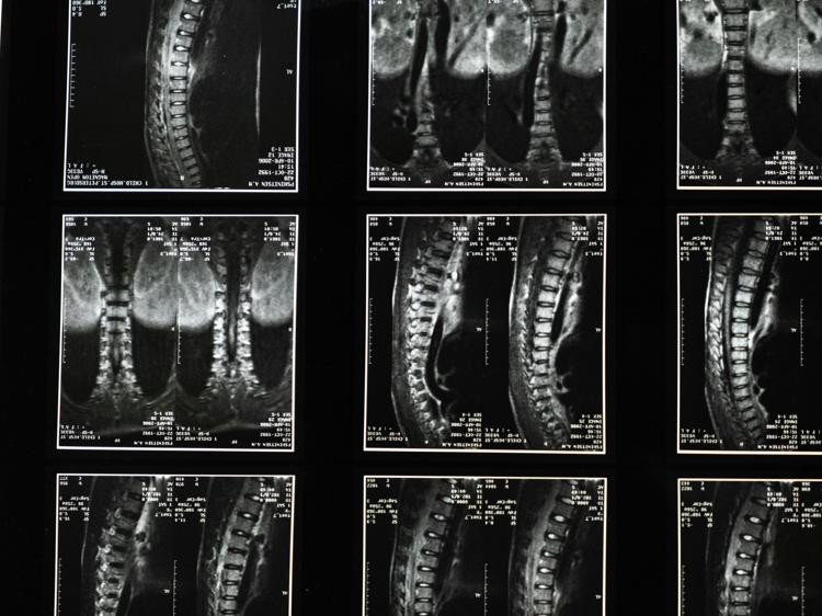 中医辅助调理脊髓炎:3个核心方法提升恢复效果(图1) 中医辅助调理脊髓炎:3个核心方法提升恢复效果