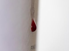 中医如何判断痛风？3个核心维度帮你精准识别